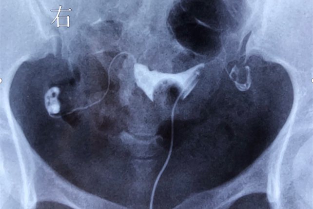 正常子宫输卵管造影图片