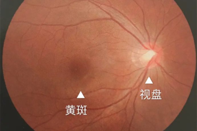 黄斑图片