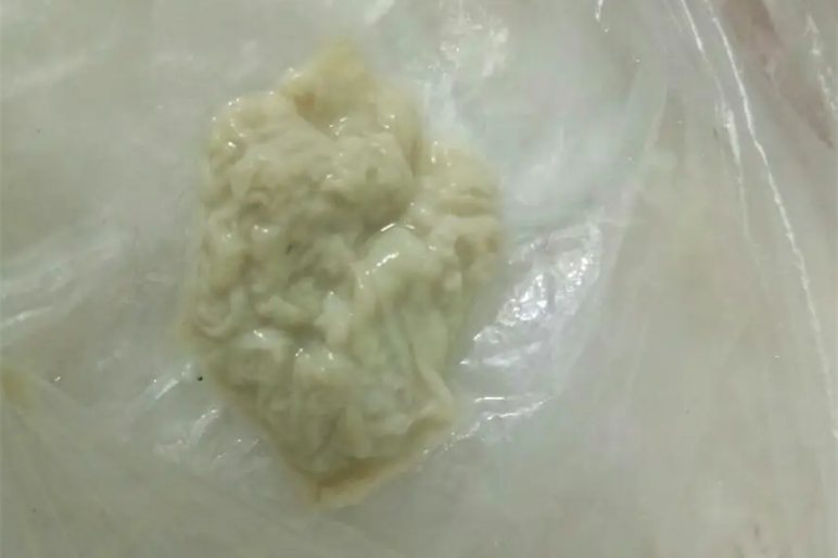 霉菌性阴道炎症分泌物图片