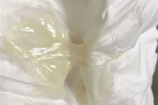 细菌性阴道炎分泌物图片