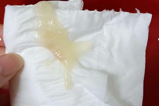 儿童妇科炎症表现图片