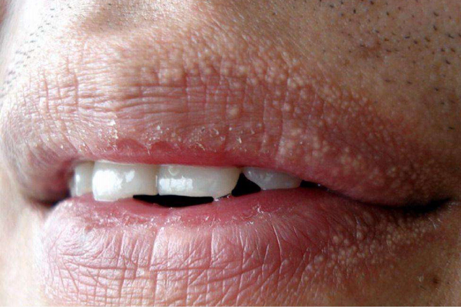 嘴唇福代斯斑点示意图