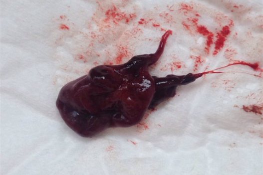 流产的症状图片