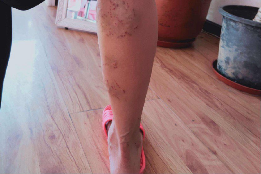 孕晚期小腿静脉曲张示意图