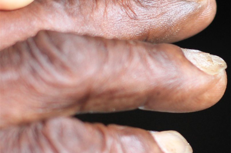 反甲和匙状甲图片