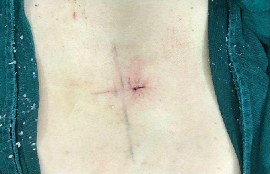腰椎微创手术伤口图