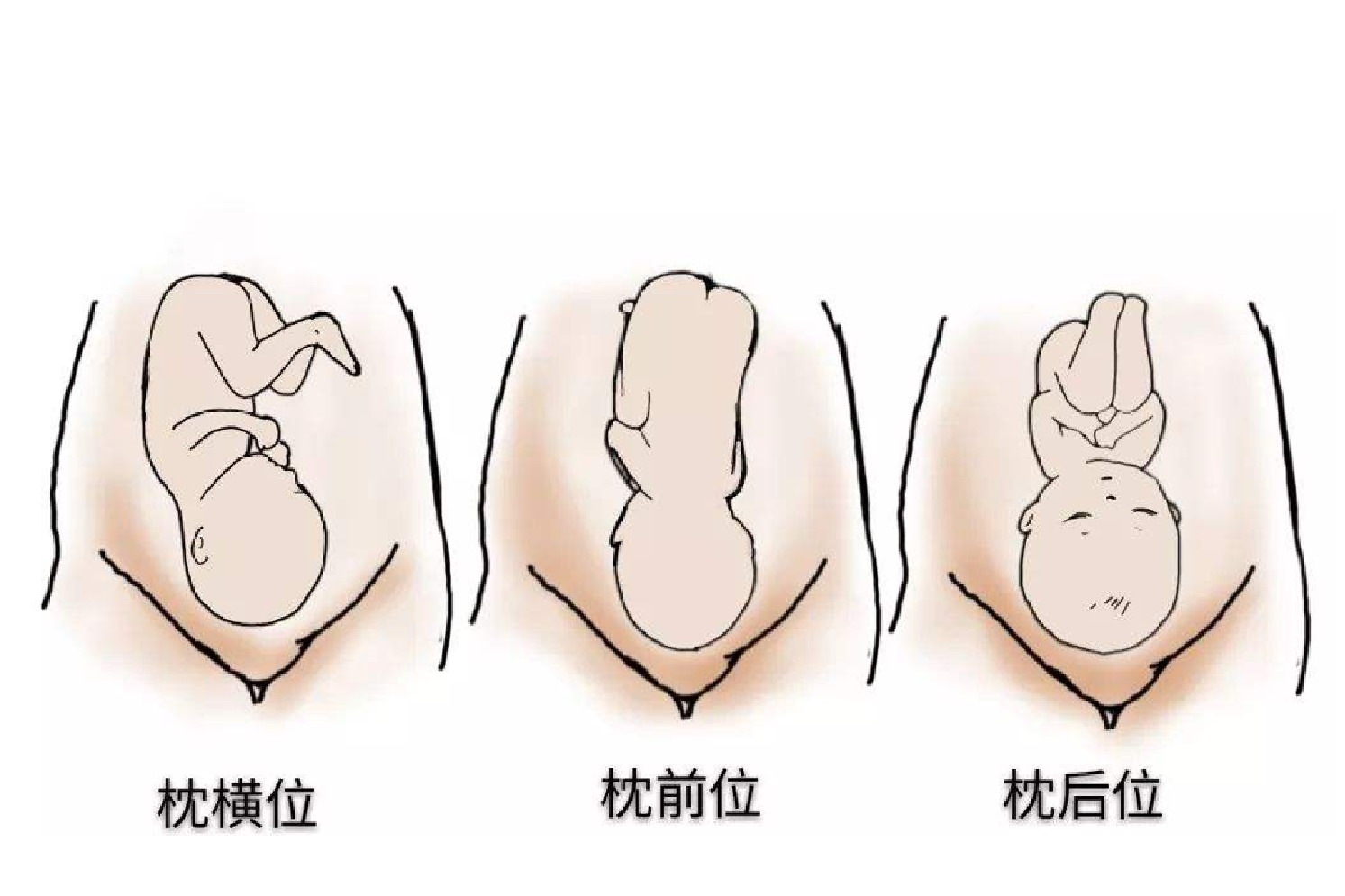 右骶横位胎位图