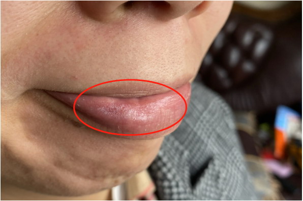 嘴巴长扁平苔藓图