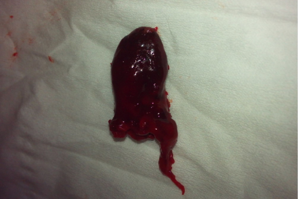 15周流产胚胎图片