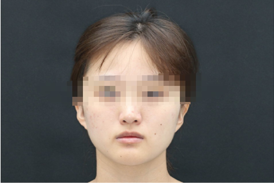 女人嘴角下垂图片