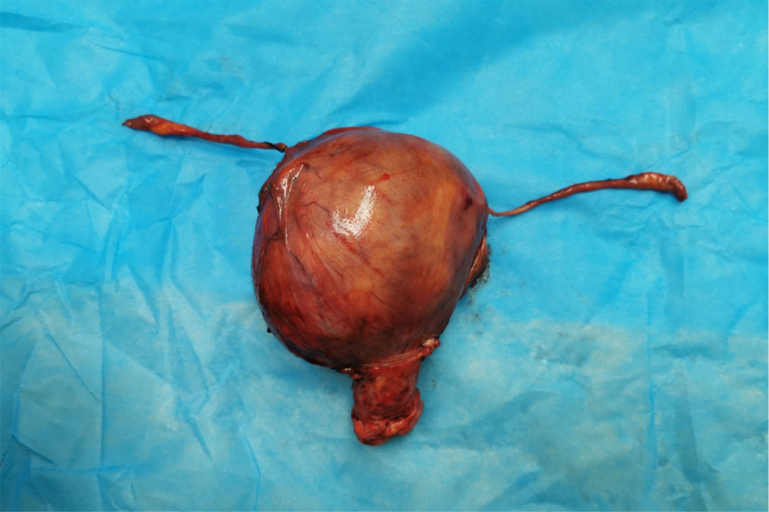 子宫肌瘤是什么样图片