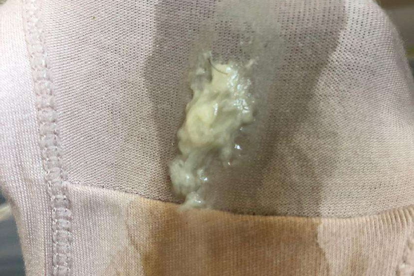 豆腐渣样白带图