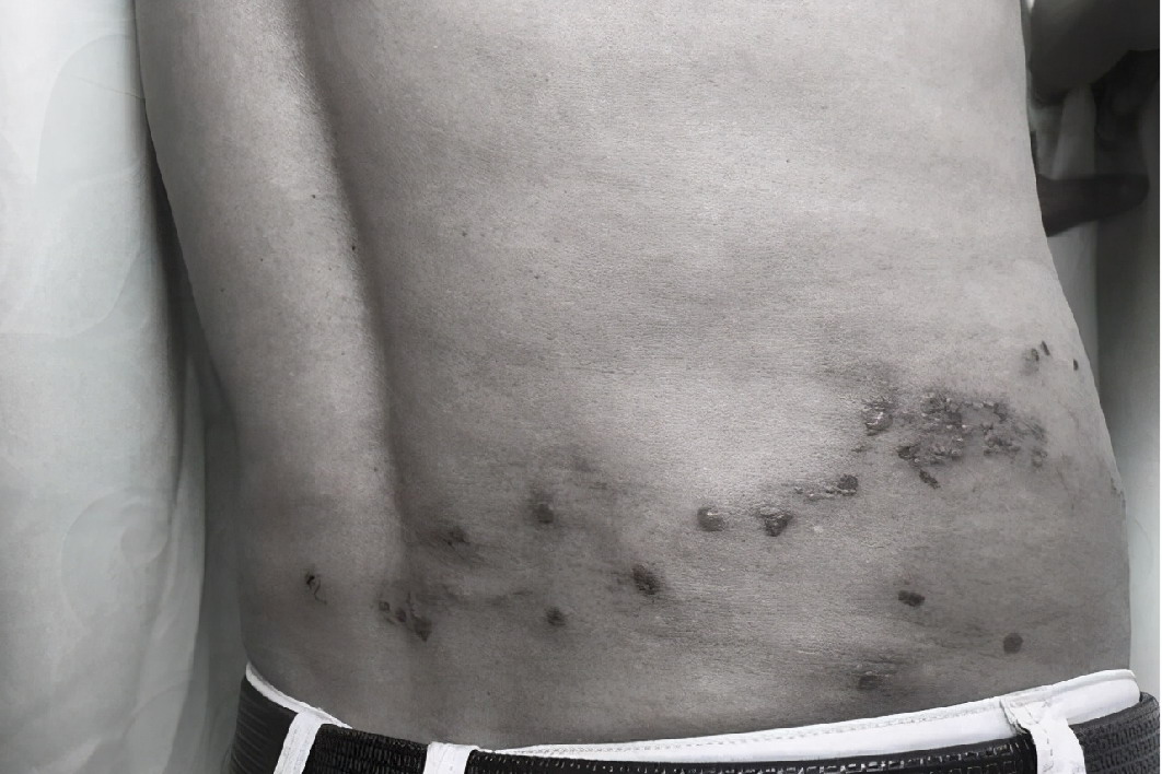 孕妇身上长疮图片