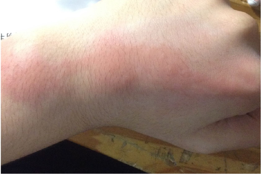 皮肤红色斑块图片