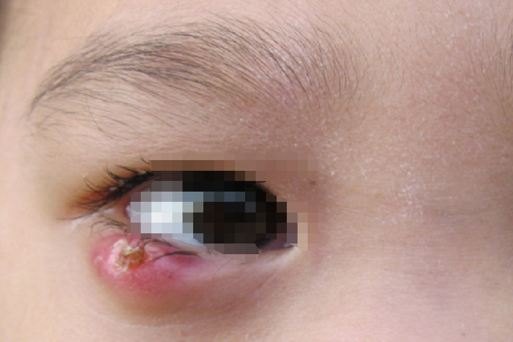 睑板腺囊肿早期图