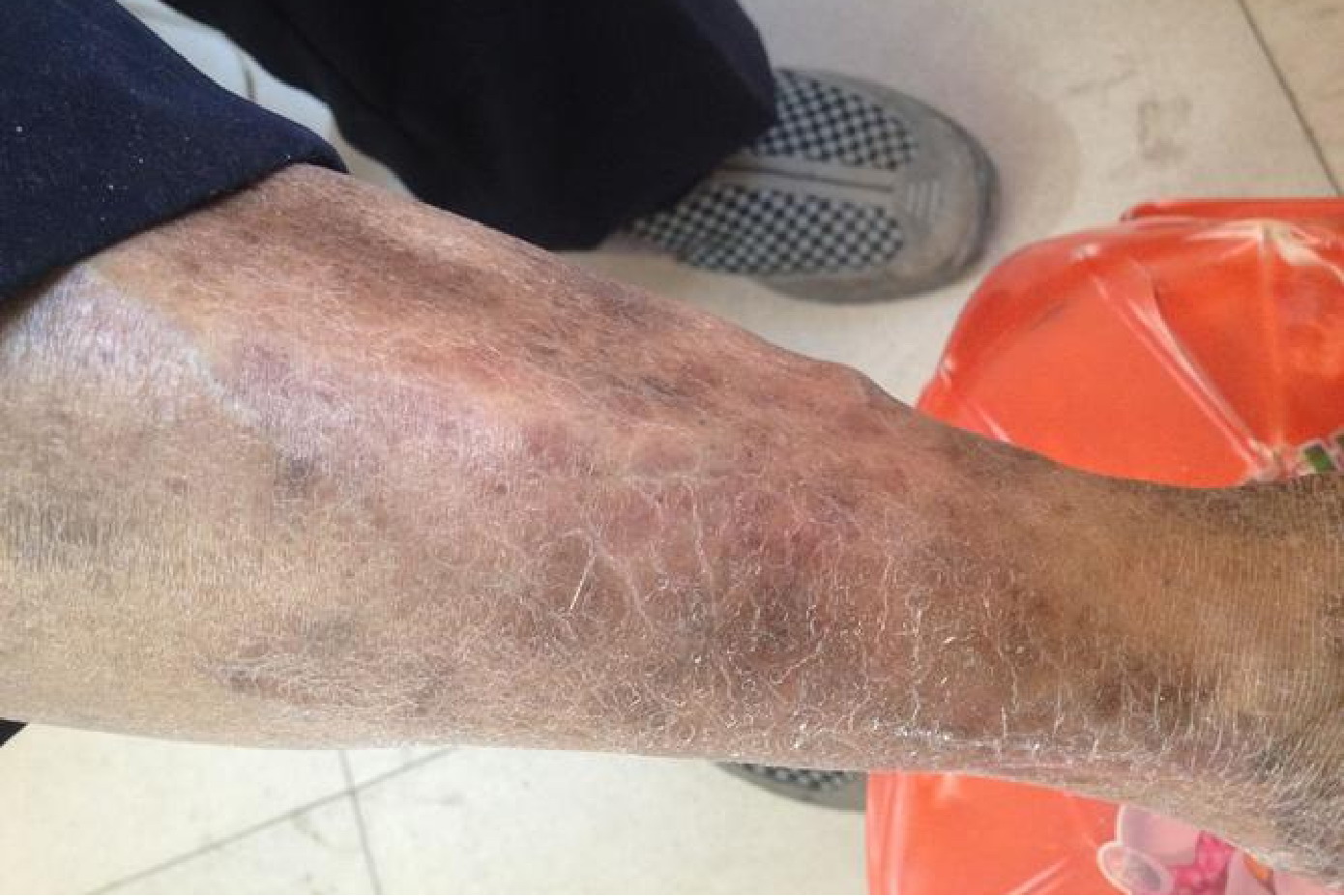 小腿黑色素斑块图片