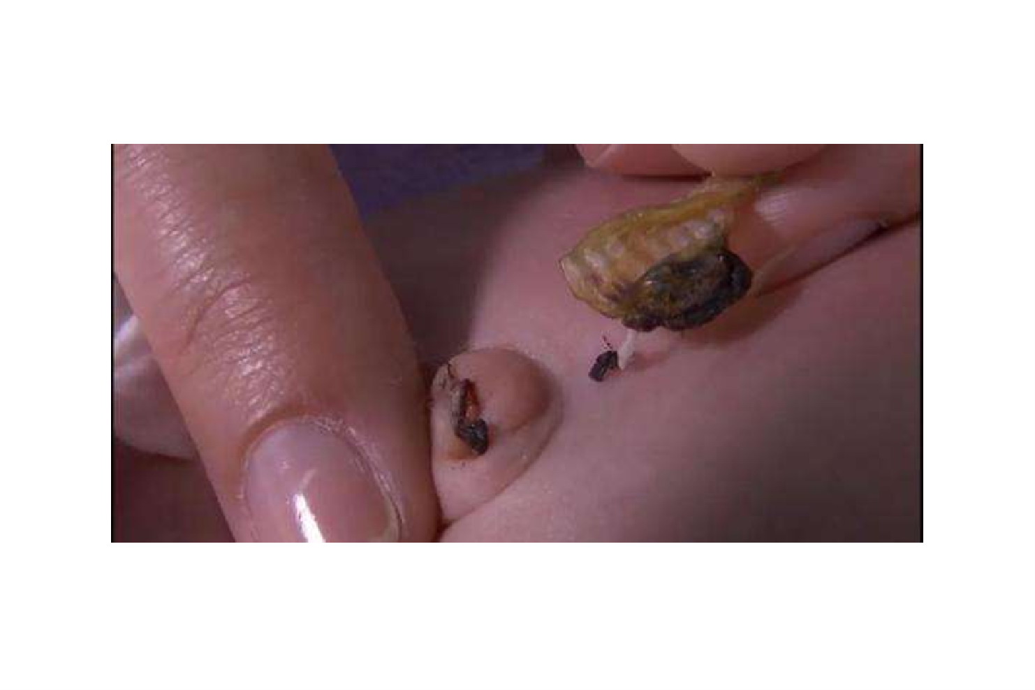 脐带连着白色管状物图