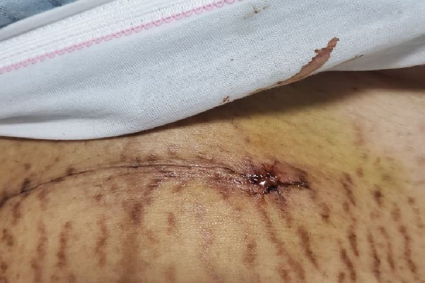 剖腹产伤口渗血水图