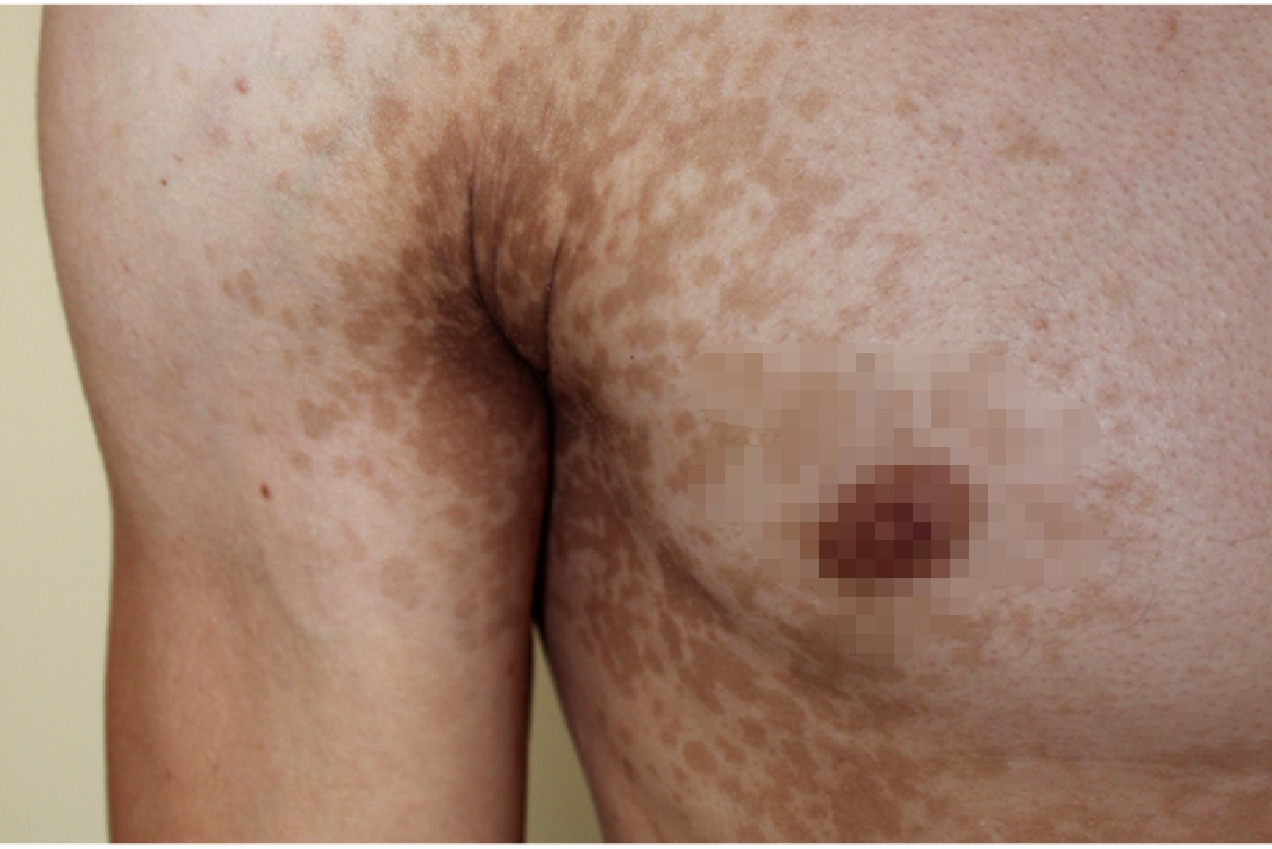 腋窝长黑圆斑图片