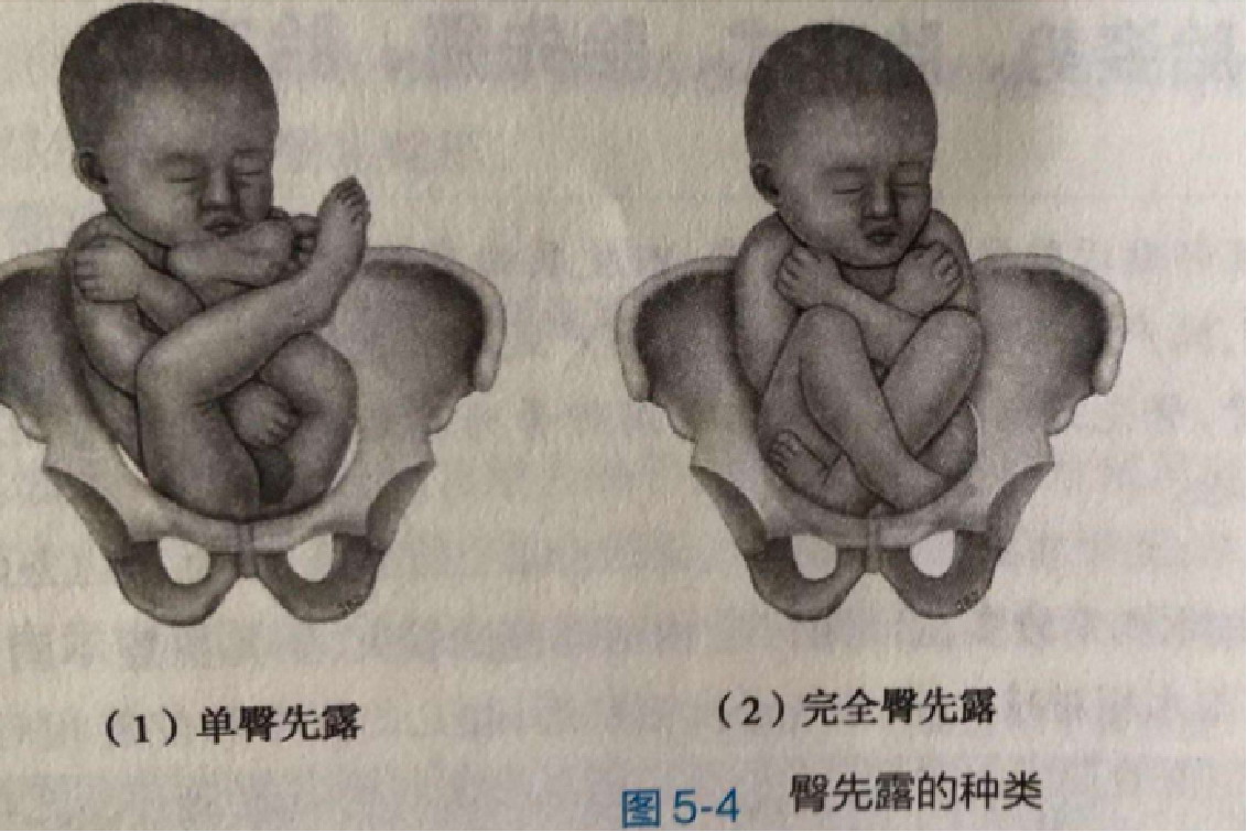 单臀先露胎儿图