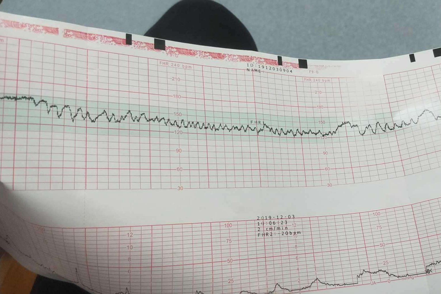 缺氧胎心监护图图片