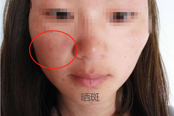 日晒斑图