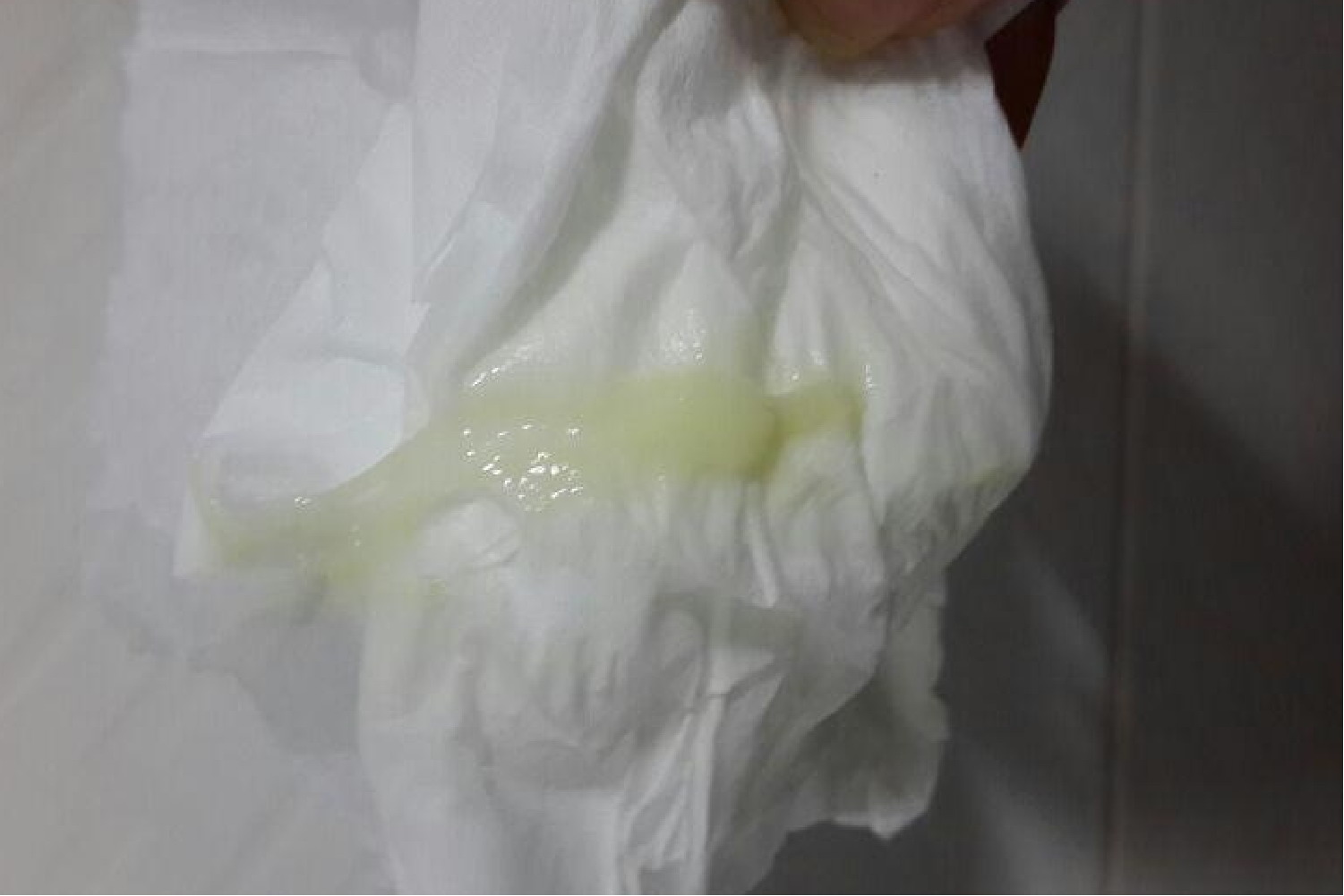 青绿色分泌物图