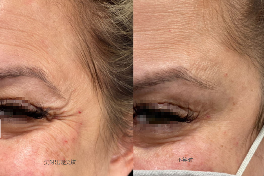 笑纹图片