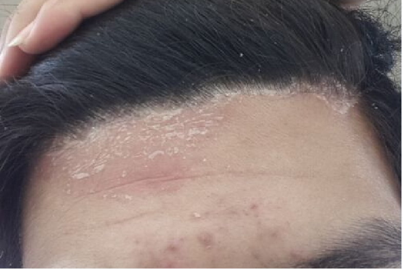 头皮脂溢性皮炎早期图