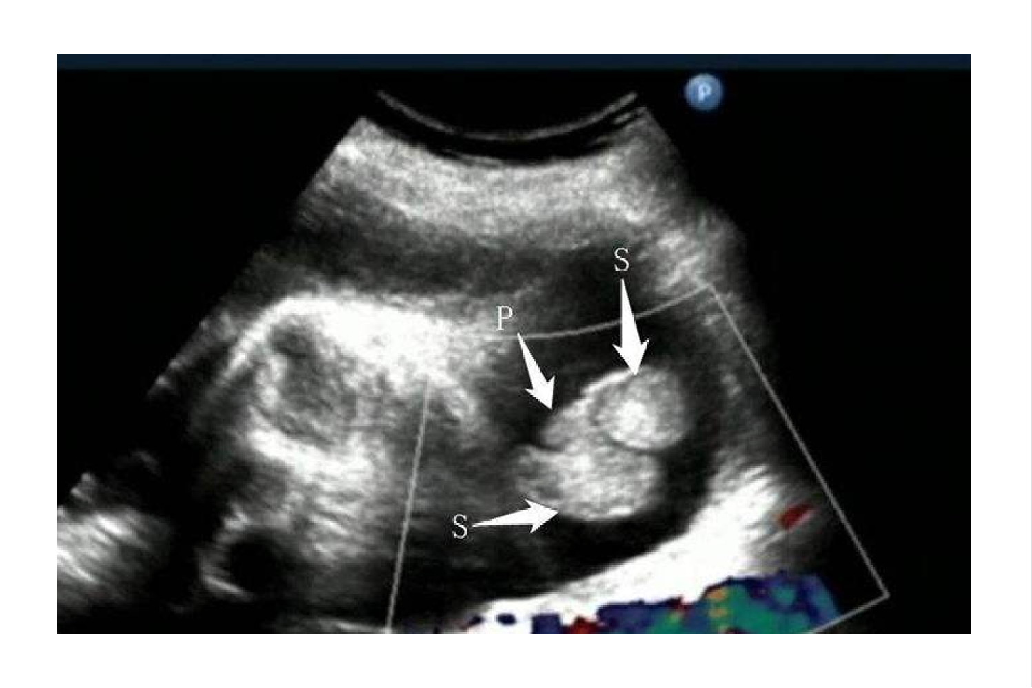 胎儿郁金香征图