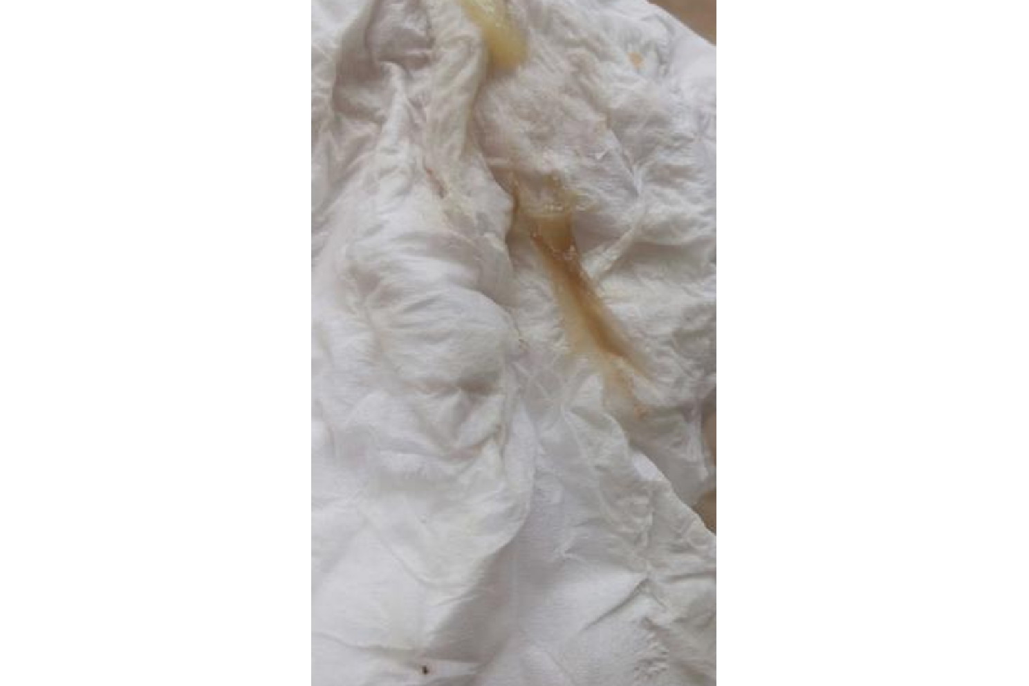 孕9周有褐色分泌物图