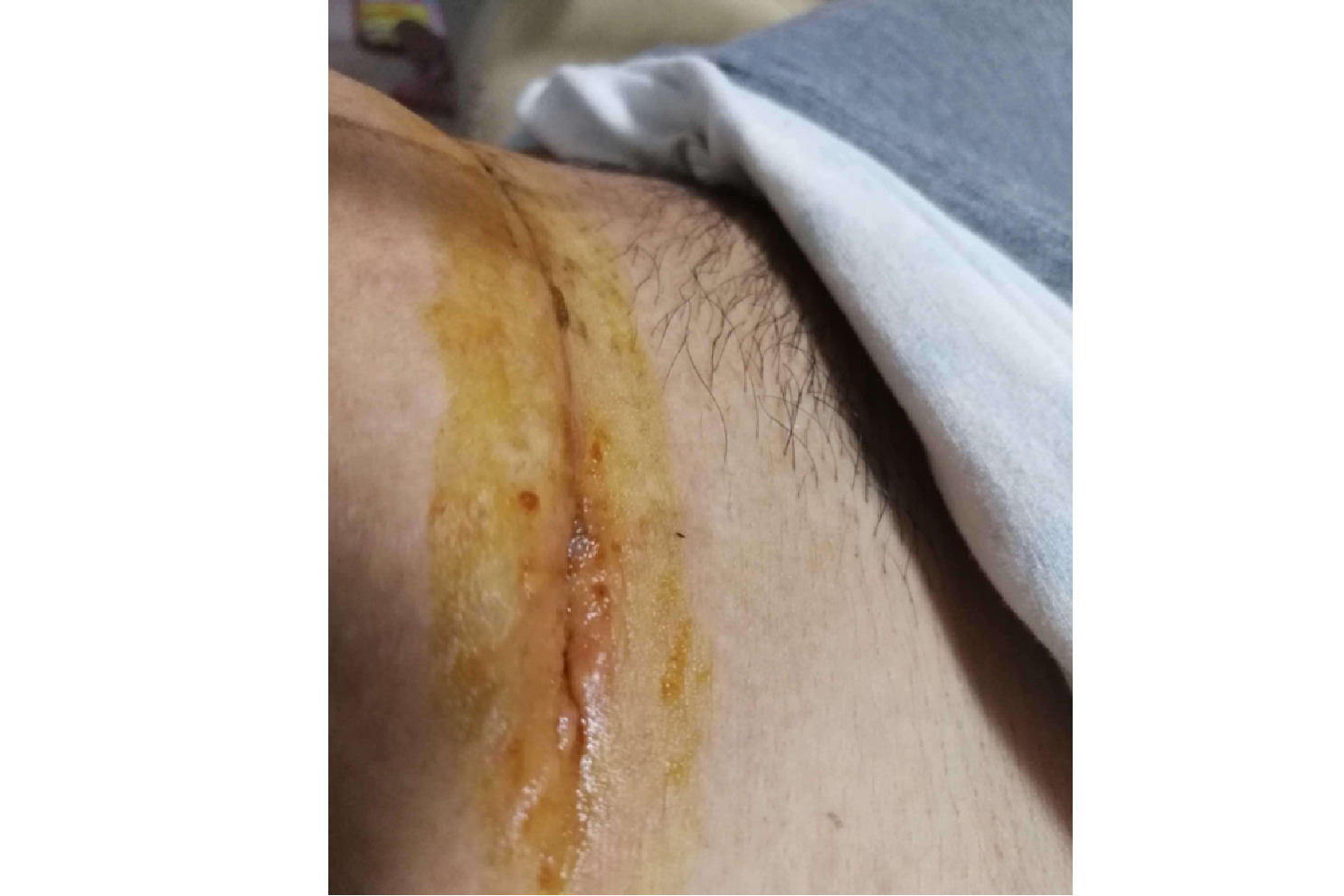 剖腹产刀口红肿图片