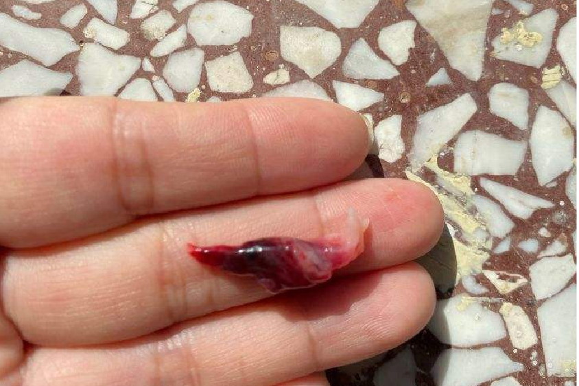 妊娠子宫内膜脱落图