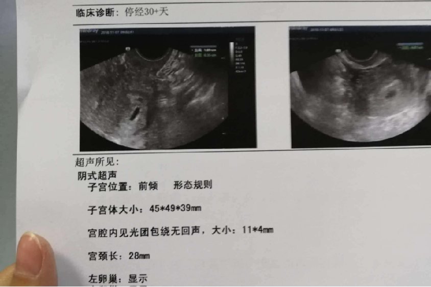 怀孕一个月彩超图片