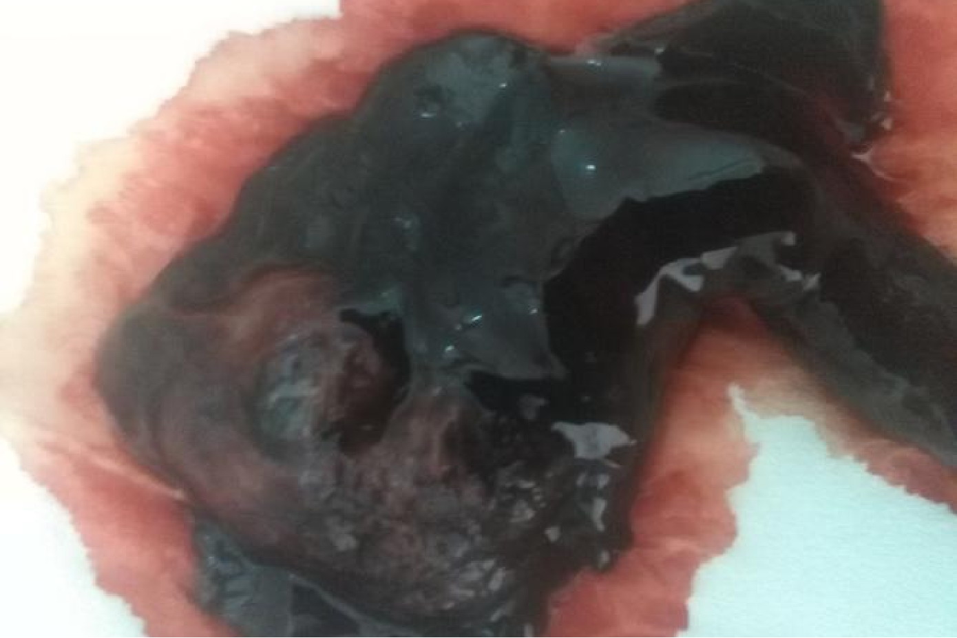 怀孕流黑色血图