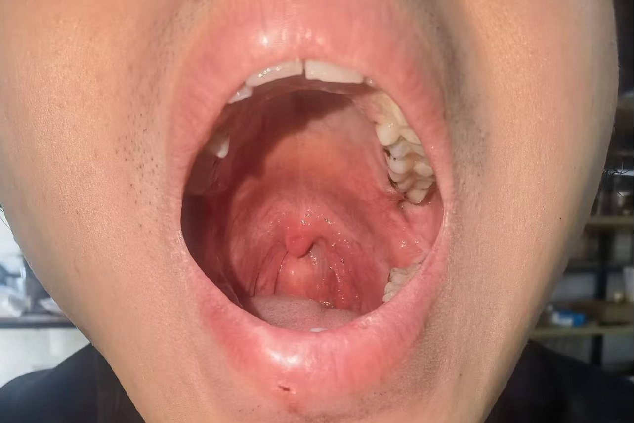 正常口腔喉咙图片