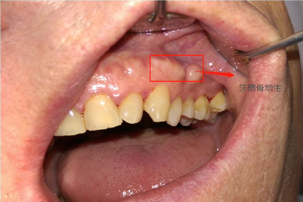 牙龈上白色凸起图片