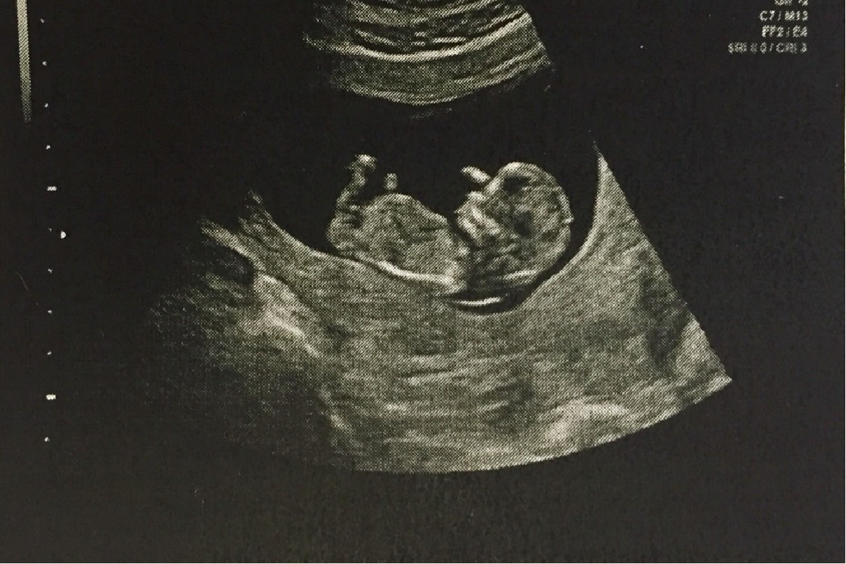 三个月的宝宝的胎盘已成型,身长大约在9