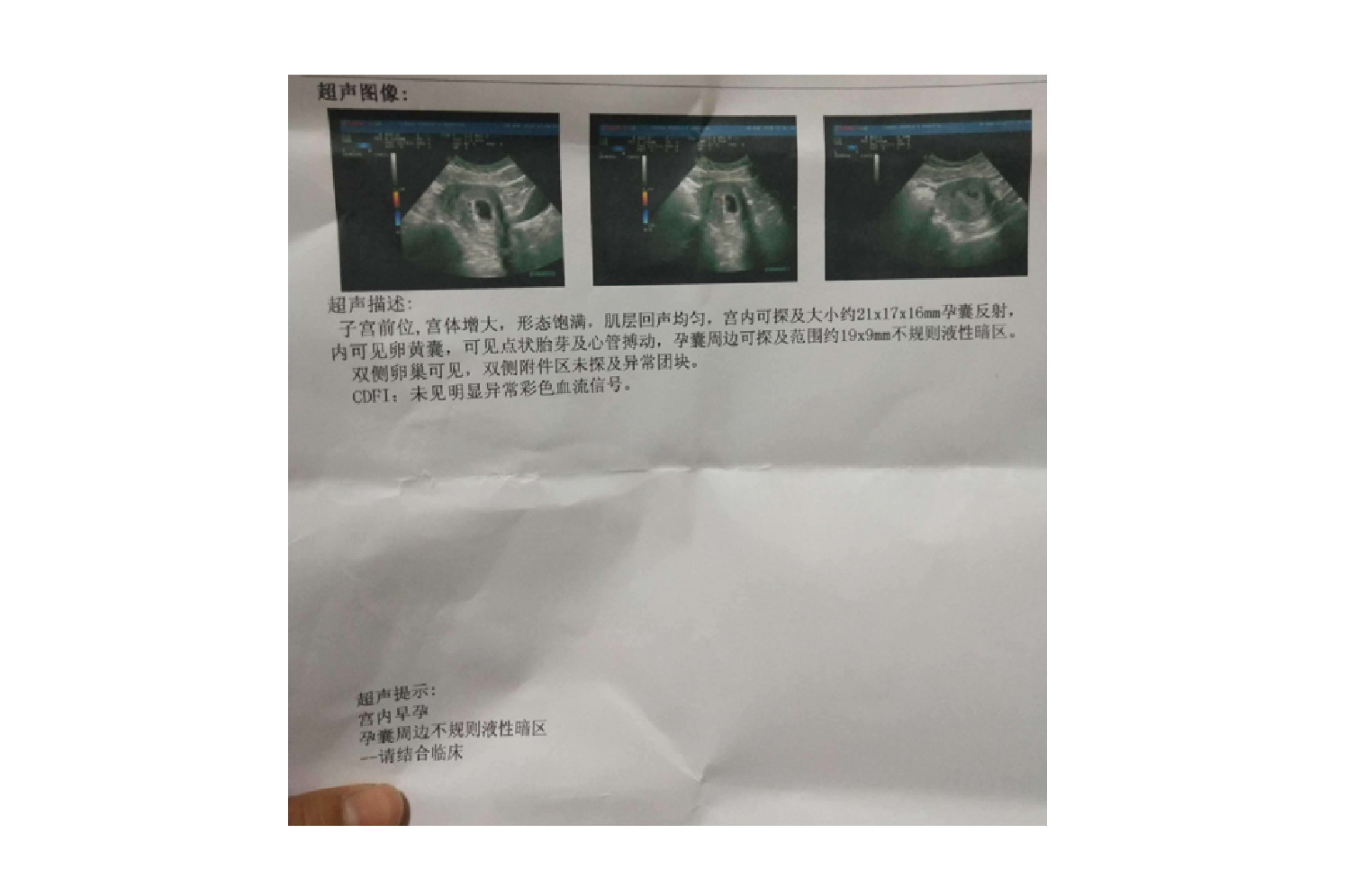 孕50天孕囊不规则图