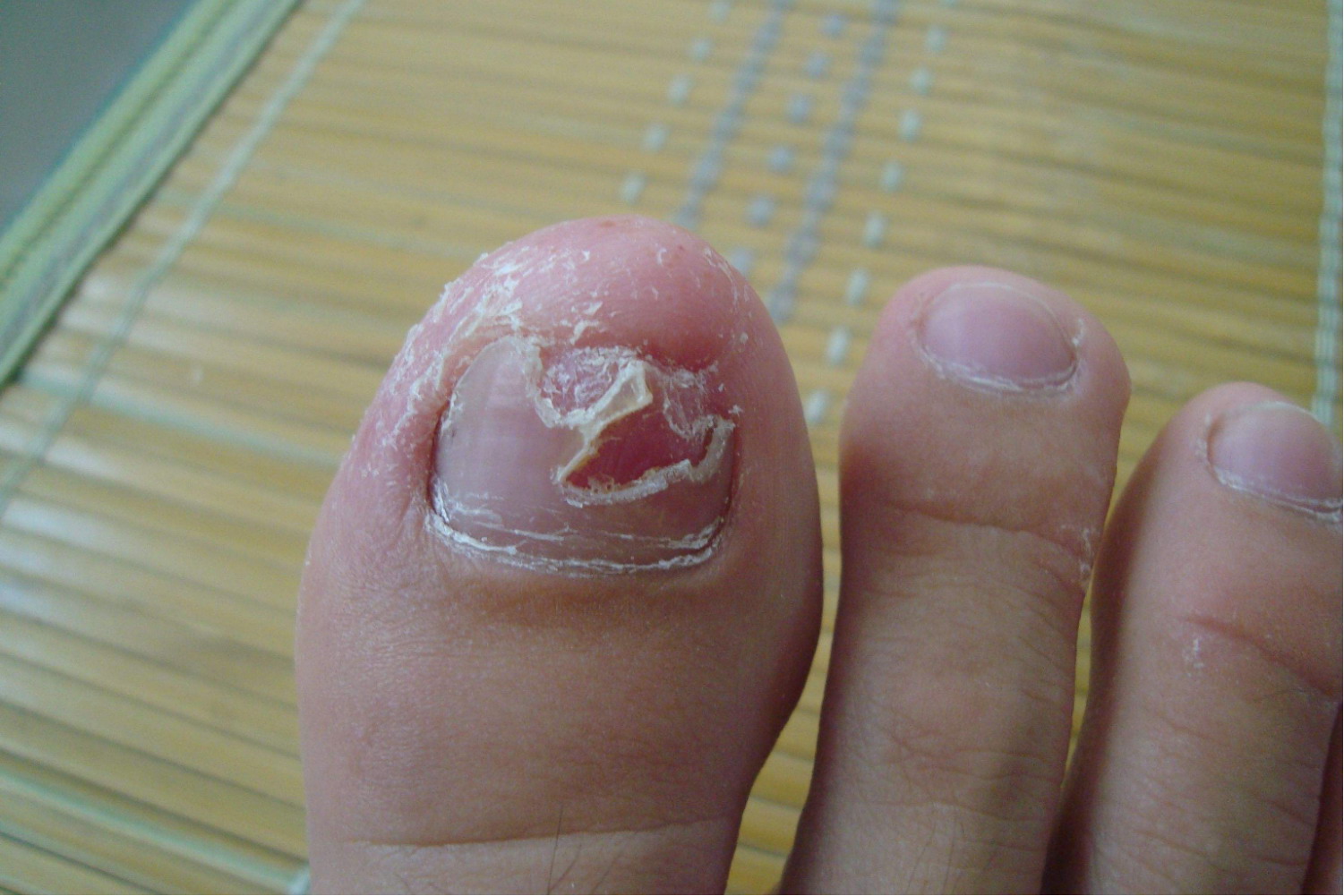 绿霉菌指甲图片