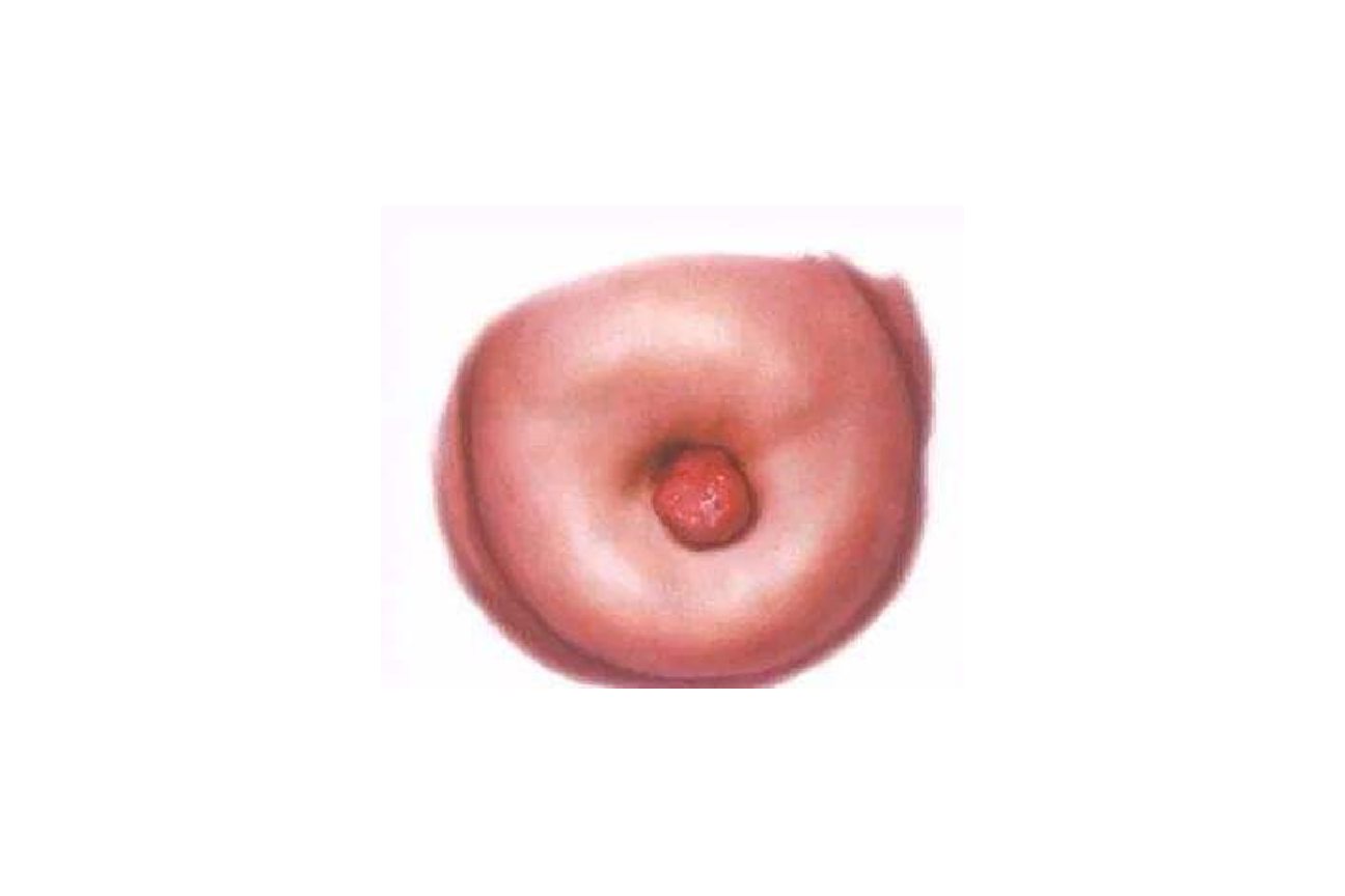 宫颈口有一坨肉凸出来图