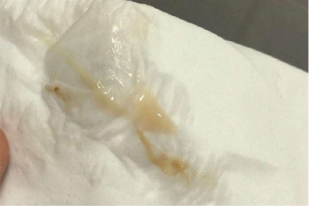 宫颈炎分泌物图