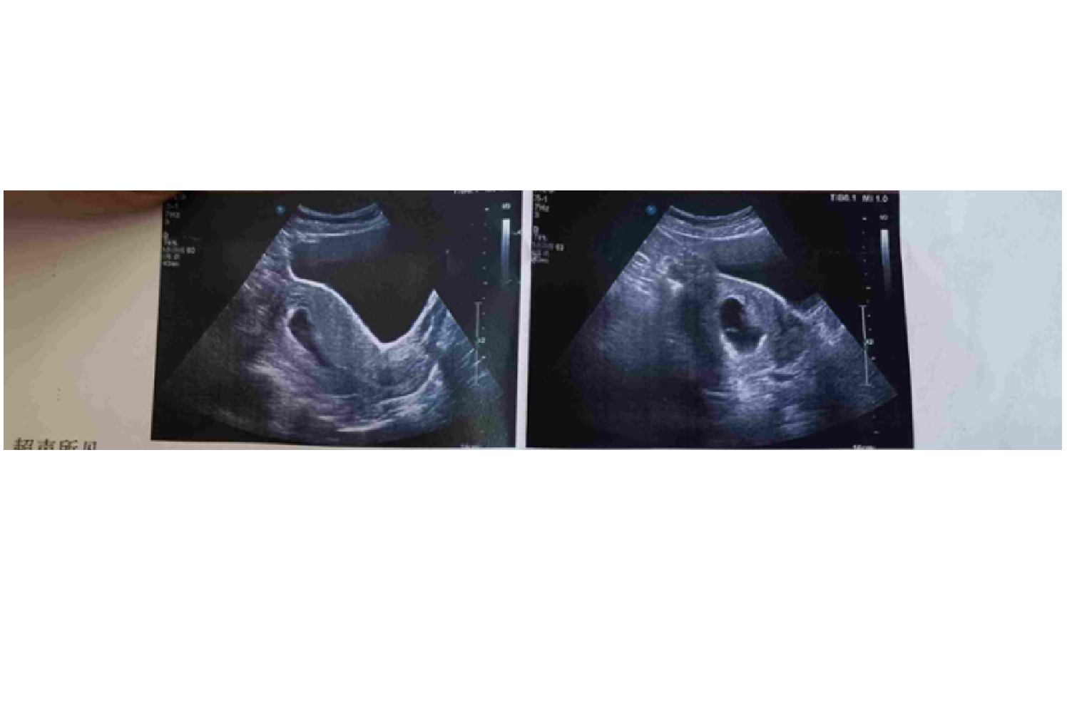 葡萄胎40天B超图