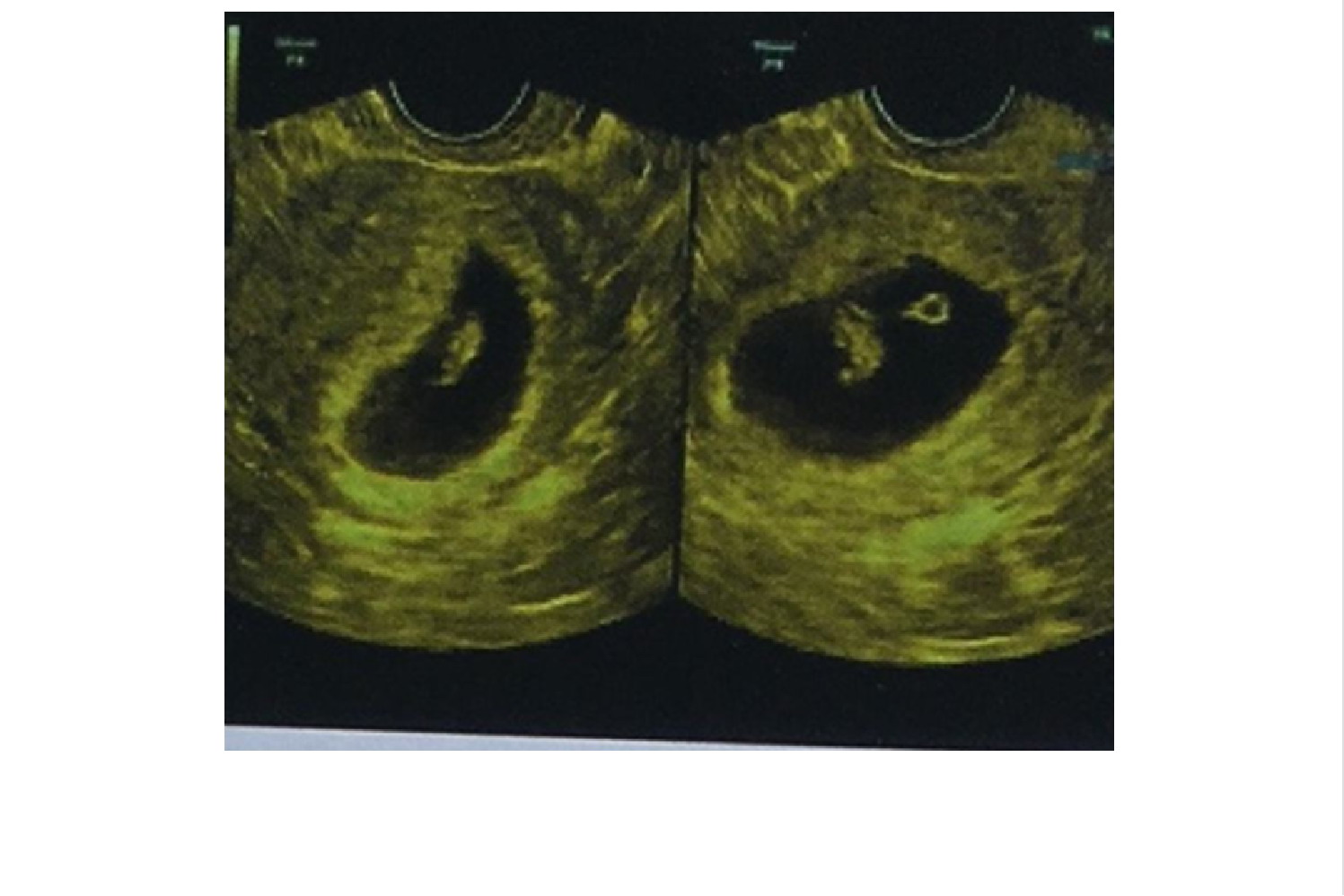 一个孕囊2个分开的白点图