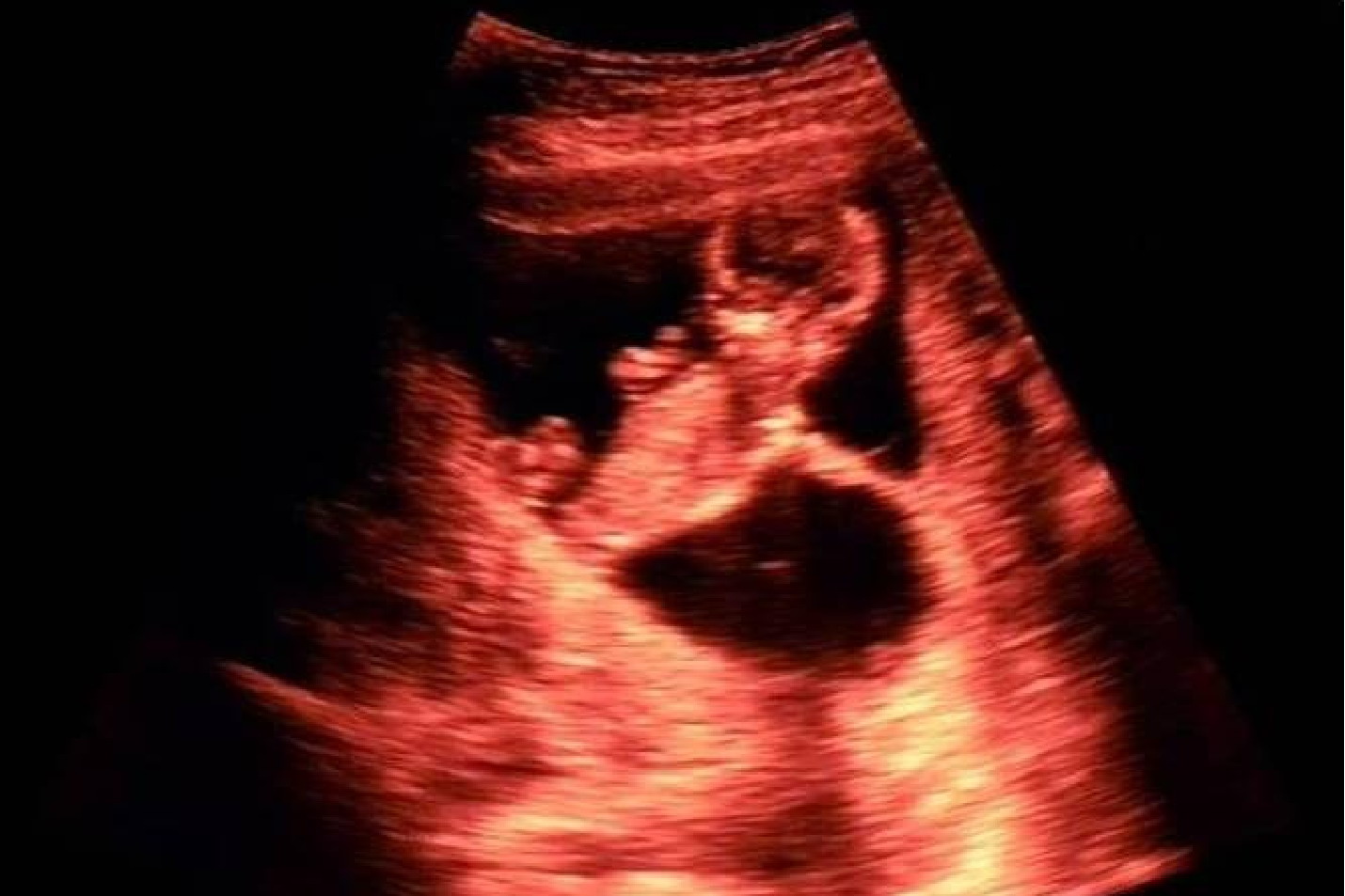 羊膜带综合征图