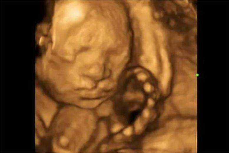 轻度唇裂四维彩超图片