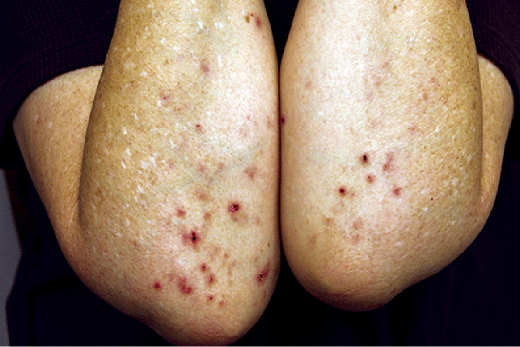 双肘对称皮疹照片