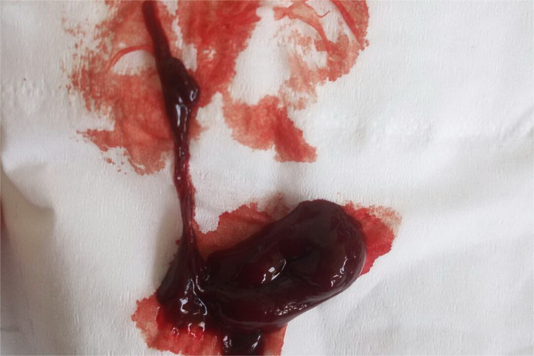 产后恶露排出绳状线条图片