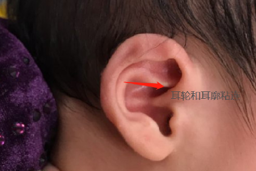 耳轮和耳廓粘连在一起图