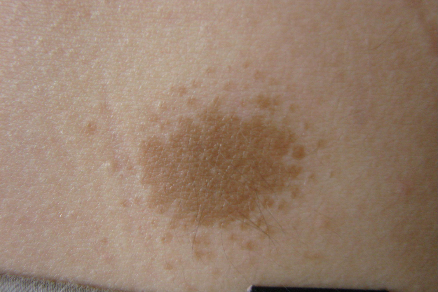 小腿上色素沉着斑图片